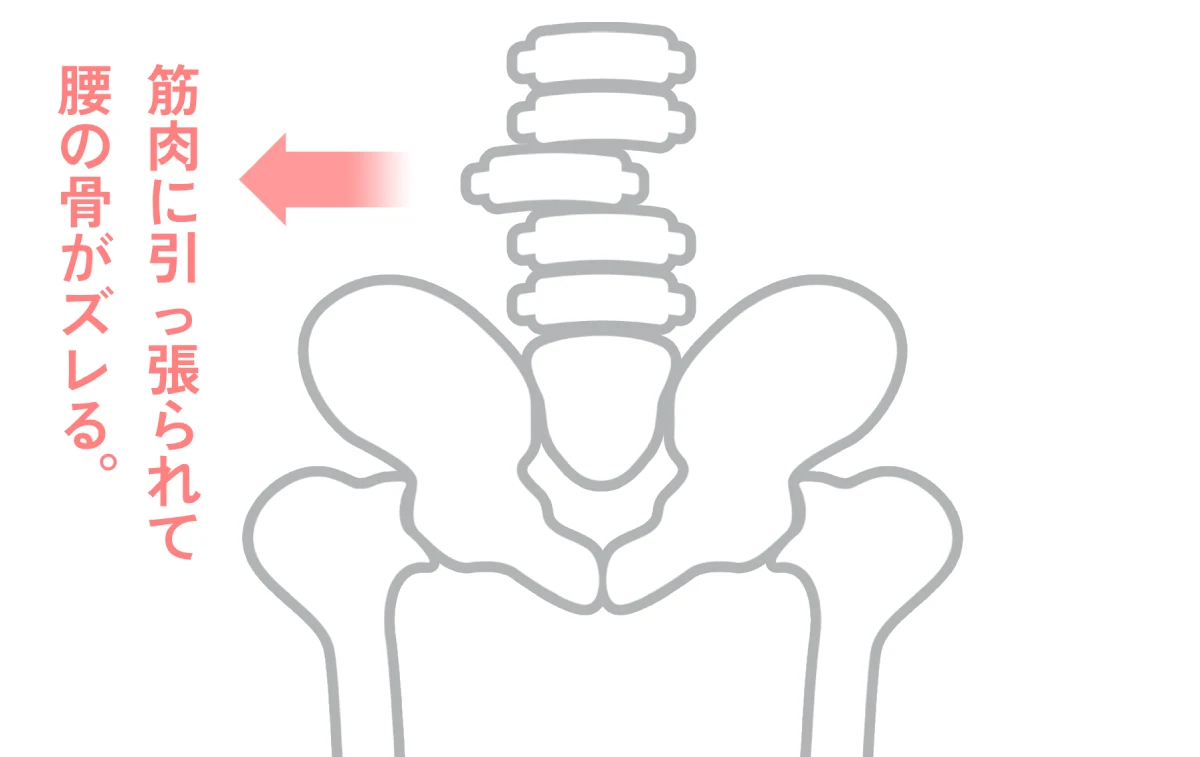 腰の骨がズレて腰痛が起きる。