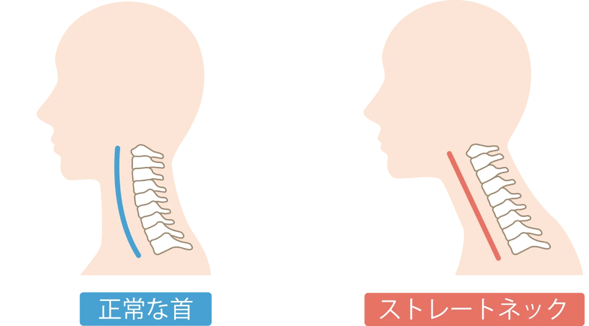 頭痛整体とストレートネック